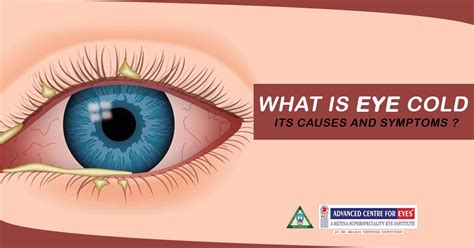 What is eye cold, its causes and symptoms? | Cold symptoms signs, Cold symptoms, Pink eye causes
