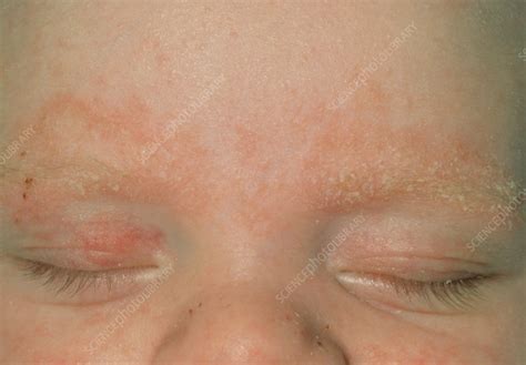 Close Up Of Seborrhoeic Dermatitis On Babys Face Stock Image M140