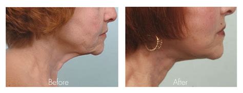 How Much Is A Neck Lift What You Should Know About Neck Lift Costs