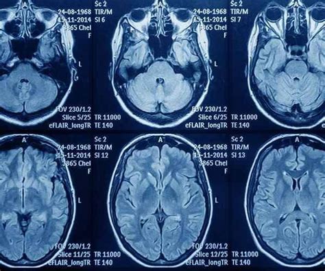 معلومات جديدة قد تساعد في علاج سرطان الدماغ