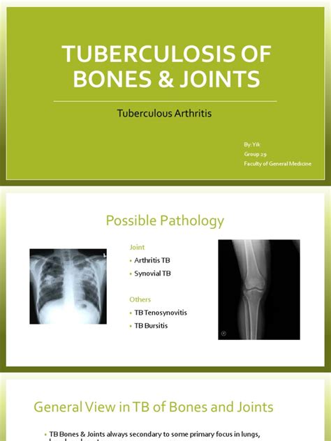 Bones And Joints Tb Pdf Tuberculosis Joint