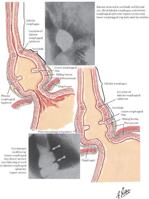 Figure 7 Pharyngeal And Esophageal Diverticula Rings And Webs Gi