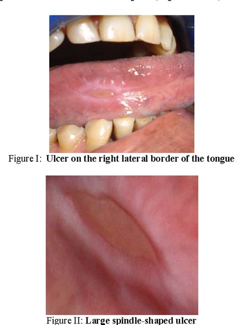 Figure I From Differential Diagnosis Of Long Term Tongue Ulcers