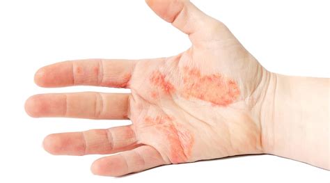 Hand Eczema Hand Dermatitis Treatment
