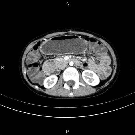 Полип сигмовидной кишки диета Полип 12-перстной кишки | Радиография Полип 12-перстной кишки | Радиография Полип сигмовидной кишки диета