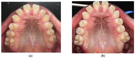 Dentistry Journal Free Full Text Efficacy Of Operculectomy In The