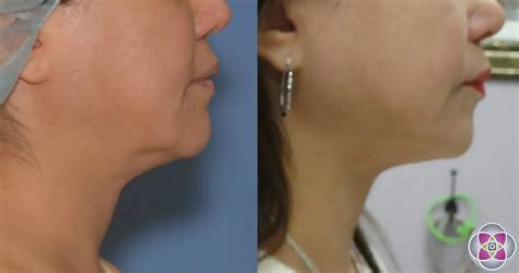 Facetite And Necktite Non Surgical Jowl And Neck Tightening