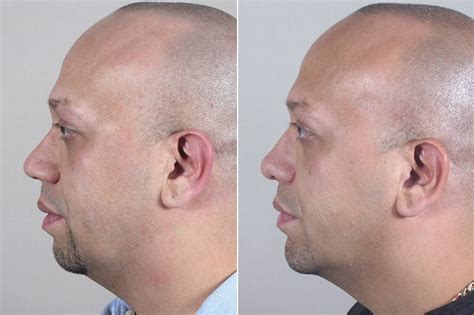 Chin Augmentation For Men New Jersey Chin Implant Parker Center For