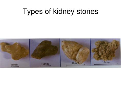 Kidney Stones Colors Types