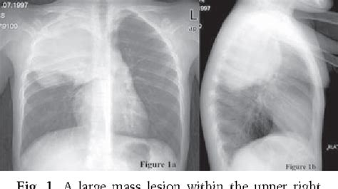 Figure 1 From Aneurysmal Bone Cyst Of Rib Presenting As A Huge Chest
