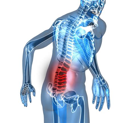 An Overview Of Lumbar Stenosis Minnesota Spine Institute
