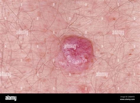Basal Cell Carcinoma Skin Cancer Close Up Of A Nodular Basal Cell