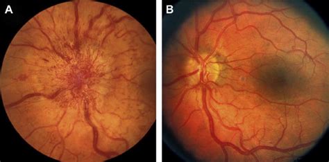 Fundus Photographs Of The Left Eye Of A 191⁄2 Year Old White Male
