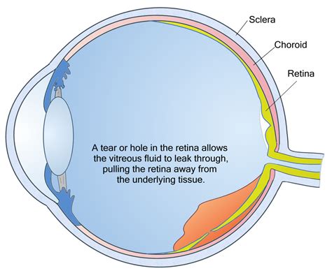 Torn Retina Treatment Retinal Tear And Detachment The Retina