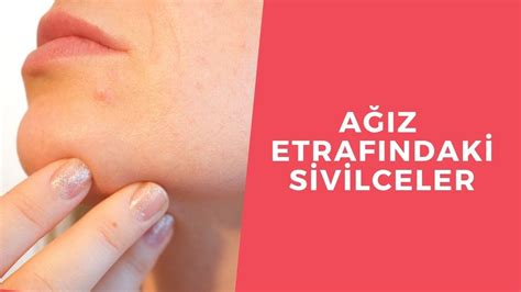 Ağız Etrafındaki Sivilceler Nasıl Geçer Perioral Dermatit Neden Olur