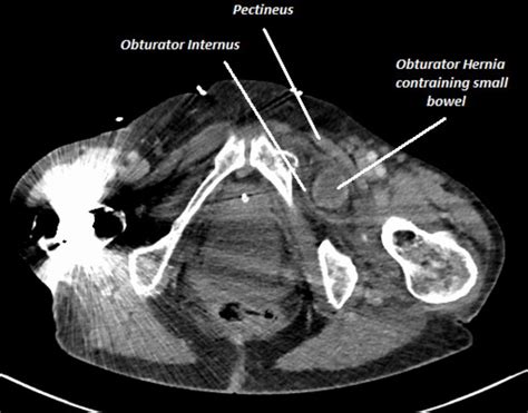 Obturator Hernia Of Richter Type A Diagnostic Dilemma Bmj Case Reports