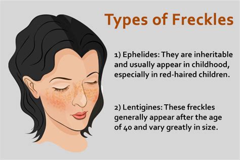 Freckles Types Causes And Medical Treatment Emedihealth
