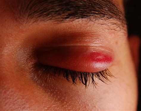 Red On Eyelid Pictures Photos
