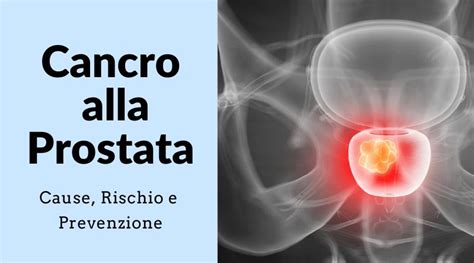 Cancro Alla Prostata 9 Cause Fattori Di Rischio E Cure