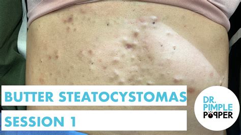 Butter Steatocystomas Session 1 Steatocystoma Station Dr Pimple