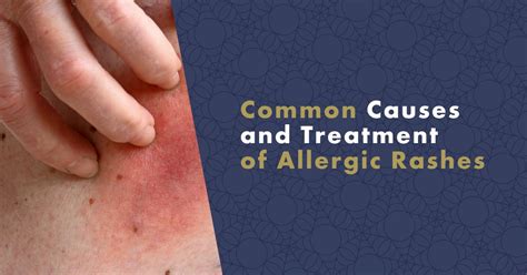 Common Causes And Treatment Of Allergic Rashes