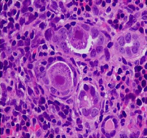 Renal Biopsy Showing Cytomegalic Inclusion Bodies In The Tubules H And