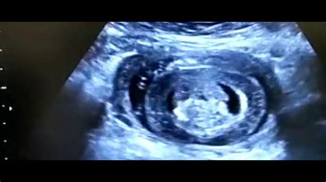 Fetal Cystic Hygroma Colli And Hydrops Fetalis Youtube