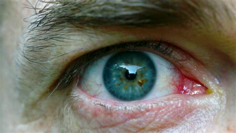 What To Do When You Get Something Like A Bug In Your Eye