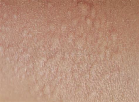 Unhealthy Irritated Human Skin Texture Covered With Allergic Bumps And