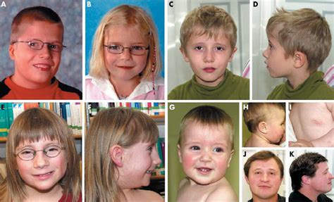 Facial Appearance Of Patients With Typical And Atypical 22q112 Download Scientific Diagram