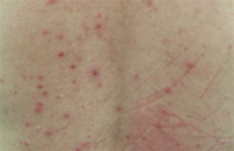 Clinical Challenge Itchy Rash On Shoulders Trunk Mpr