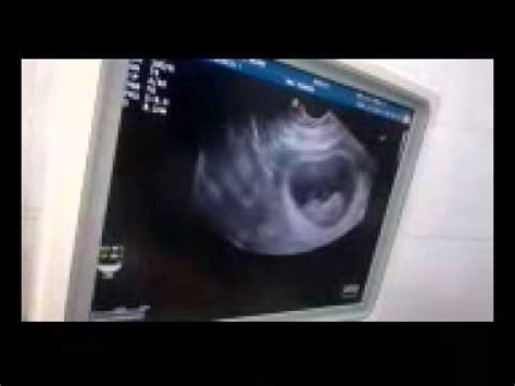 10 semanas de embarazo imagenes. ecografia de 10 semanas de niña. nuestra bebe - YouTube