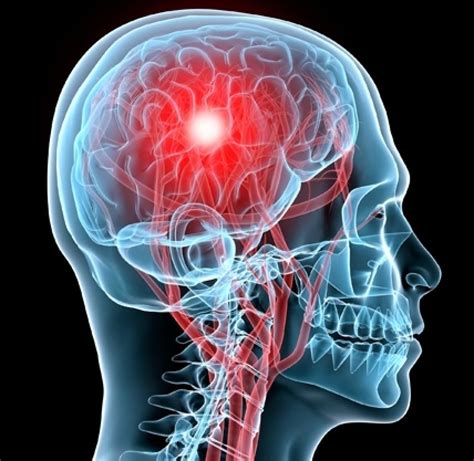 7 Symptoms Of Concussions And How To Address Them Impact Physical Therapy