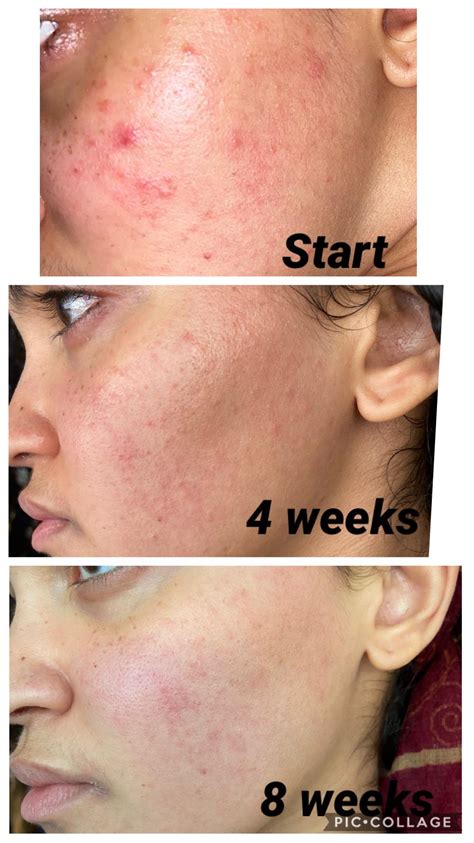 2 Months On 004 Tretinoin Microsphere Tretinoin