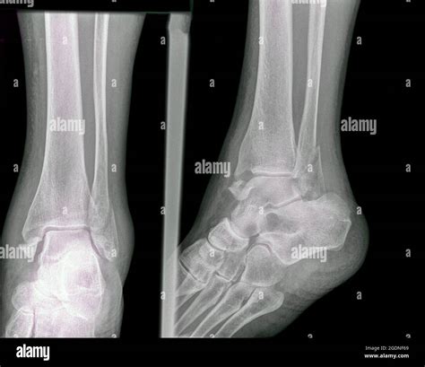 Fracture Of The Distal Tibia And Fibula X Ray Of A 57 Year Old Male