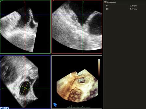 Application Of Three Dimensional Ultrasound In Left Atrial Appendage