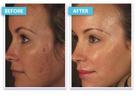 Before And After Laser Skin Rejuvenation Laser Skin Rejuvenation