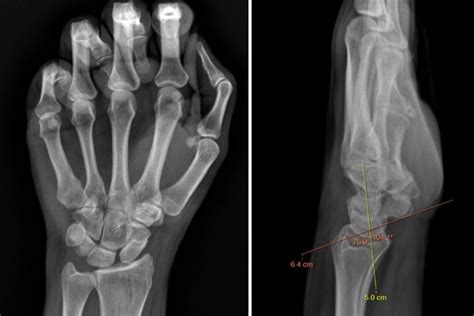 A Year Old Woman With Wrist Pain After Hearing A Snap Journal Of Urgent Care Medicine