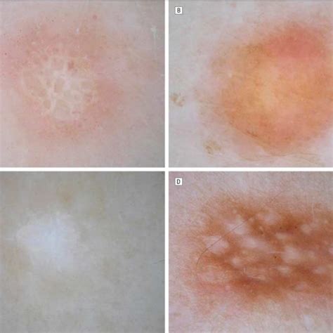 Vascular Structures In Dermatofibromas A Dermatofibroma Pattern 2