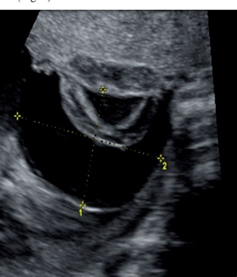 Figure 1 From Prenatal Diagnosis Of Multiple Large Subchorionic
