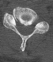 Prolapsed Intervertebral Disk - Clinical Radiology - GUWS ...