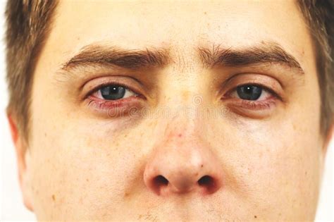 Red Eye Disease Drakengard Common Causes Of Red Eye Diseases Club