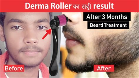 Derma Roller Result After Months Derma Roller Beard Treatment Youtube
