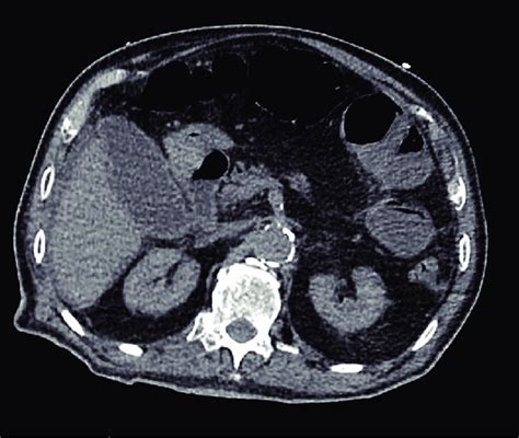 Axial View Of A Contrast Enhanced Ct Of The Abdomen Demonstrating A