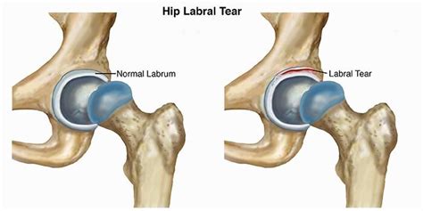 Hip Dislocation How To Diagnose Treat And Prevent A Serious Injury
