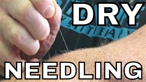 Why Am I Sticking Needles In My Arm Dry Needling Of The Supinator Youtube