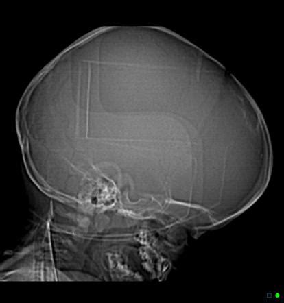 Frontal Bossing Radiology Reference Article Radiopaedia Org