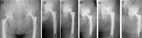 Radiographs Pelvic Anteroposterior Ap View A Primary Total Hip