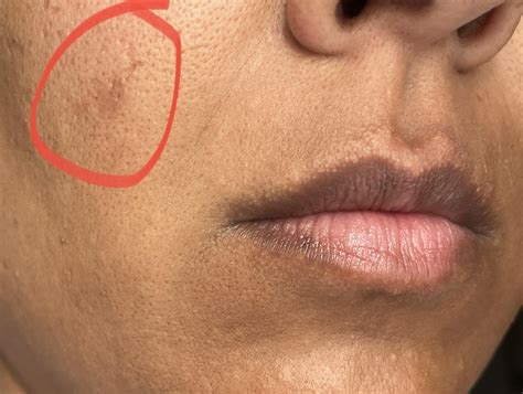 [Product Request] - Popped Blackhead : r/SkincareAddiction