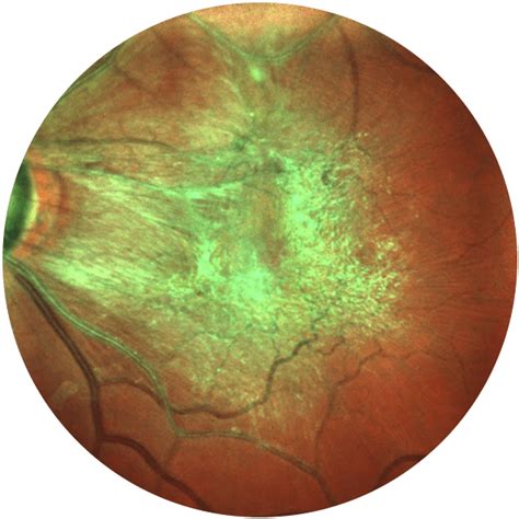 Retina Consultants Of Southern Colorado Epiretinal Membrane Macular